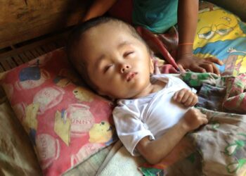 Si Baby Aki at ang sakit na hydrocephalus