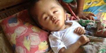 Si Baby Aki at ang sakit na hydrocephalus