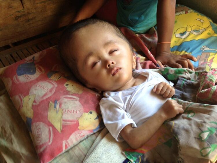 Si Baby Aki at ang sakit na hydrocephalus