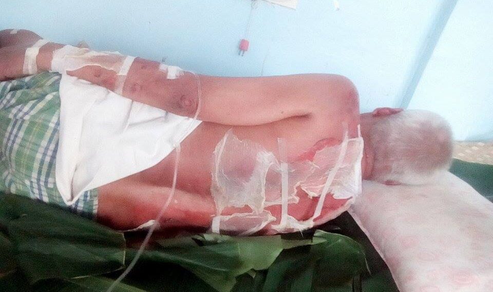 80-taong gulang na Lolo, sugatan sa sunog sa Corcuera