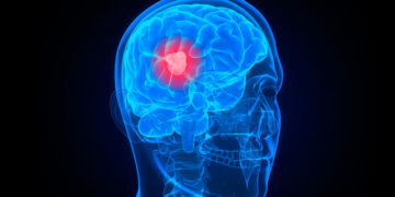 Brain cancer vaccine effective in some patients