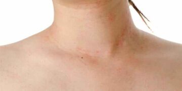 PHO, DOH reminds public of 4S strategy vs dengue