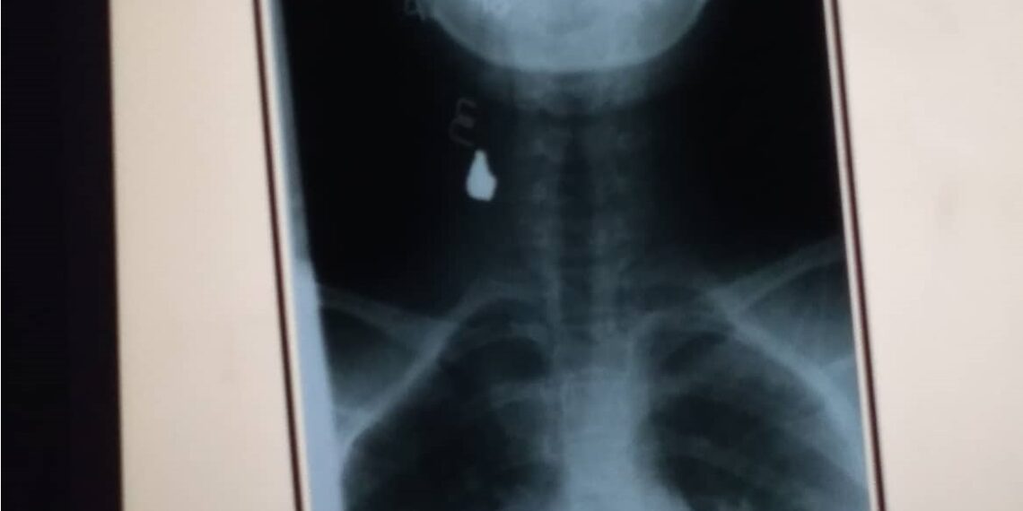 Kopya ng XRay result kung saan makikita ang lokasyon ng pumasok na bala sa may leeg ng biktima