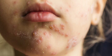 Experts warn public vs. measles complications