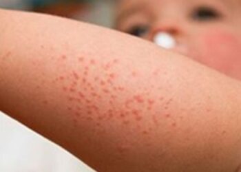 Decreasing trend in measles cases in Romblon seen