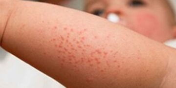 Decreasing trend in measles cases in Romblon seen