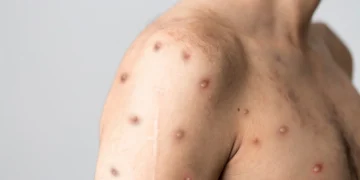 WHO declares mutli-country monkeypox outbreak int’l public health emergency