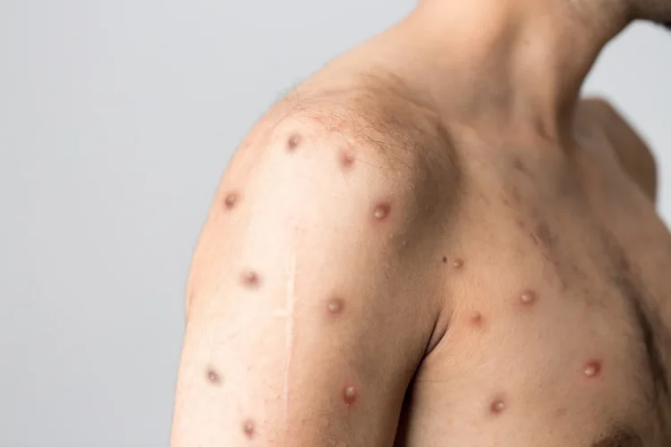 WHO declares mutli-country monkeypox outbreak int’l public health emergency