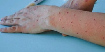 DOH naglabas ng bagong gabay sa pag-iwas sa Mpox