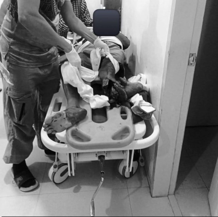 Lolo sa Looc naputulan ng paa matapos ma-hit-and-run ng SUV