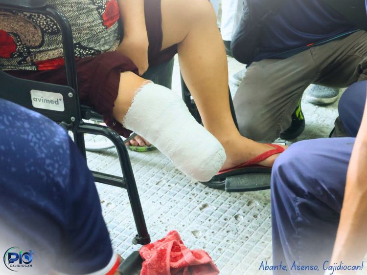 21 PWD sa Sibuyan, sinukatan para sa libreng prosthetic arms at legs